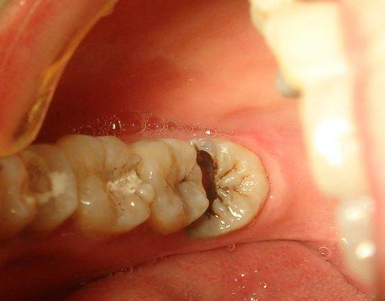 牙髓炎图片 (3)