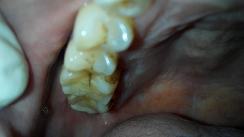 牙髓炎图片 (35)