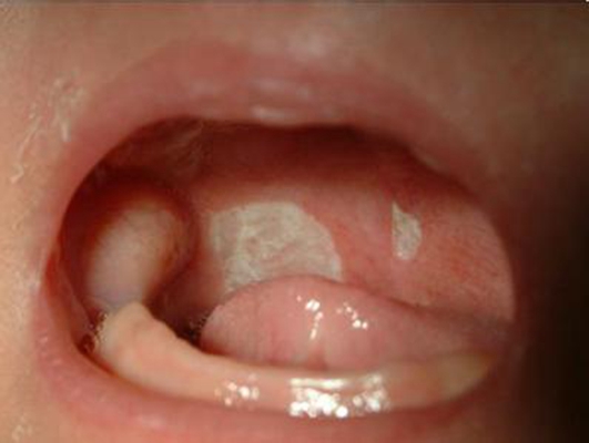 口腔念珠菌感染 (31)