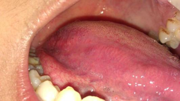 口腔念珠菌感染 (34)