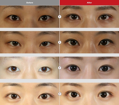双眼皮修复 (6)