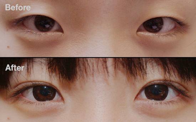 双眼皮修复 (9)