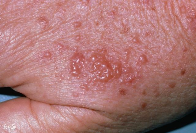 其实总结一下,怎么样杜绝螨虫,第一步是要预防!