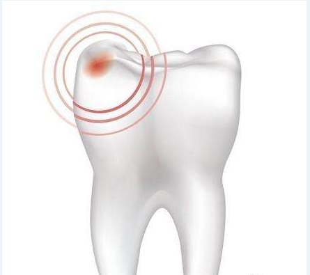 牙髓炎图片 (1)