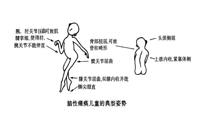 脑瘫的早期症状图片 (23)