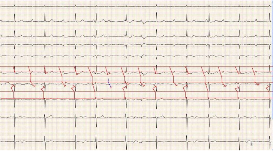 偶发房性早搏 (21)