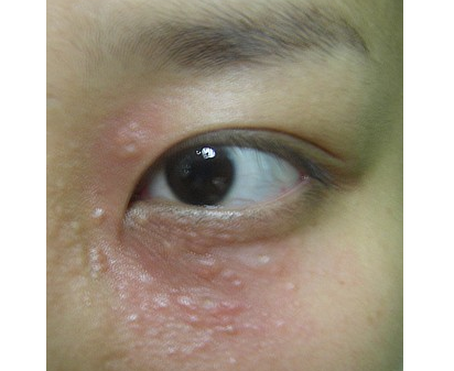 汗管瘤图片眼部图片 (4)