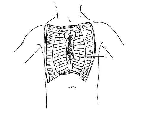 肋间神经炎疼痛部位图片 (48)
