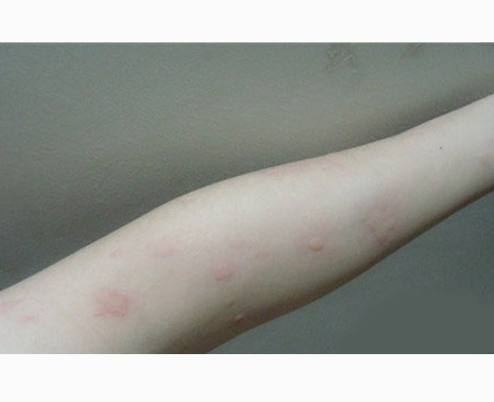 大人风疹的症状图片 (10)