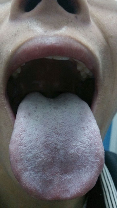 舌苔厚白图片 (1)