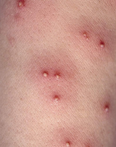 艾滋病早期皮疹水泡图片