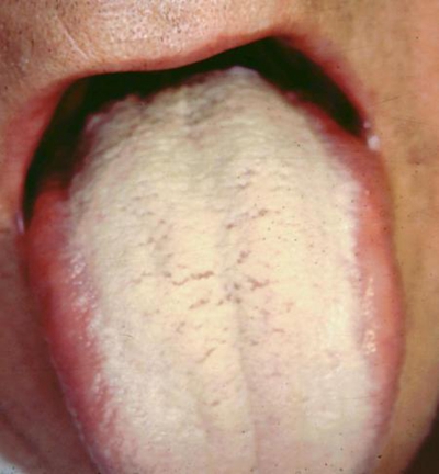 舌苔厚白图片 (37)