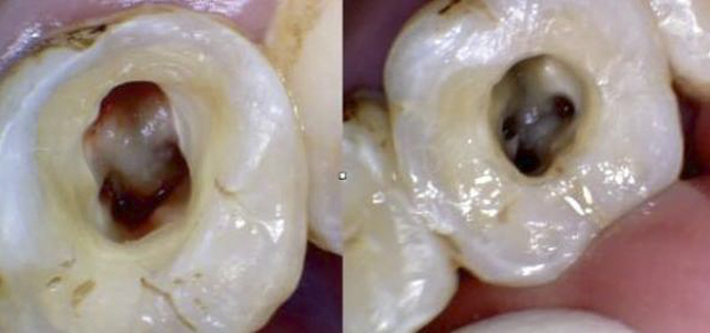 牙髓炎图片 (41)