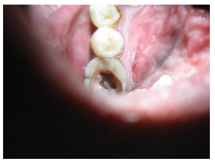 牙髓炎图片 (5)