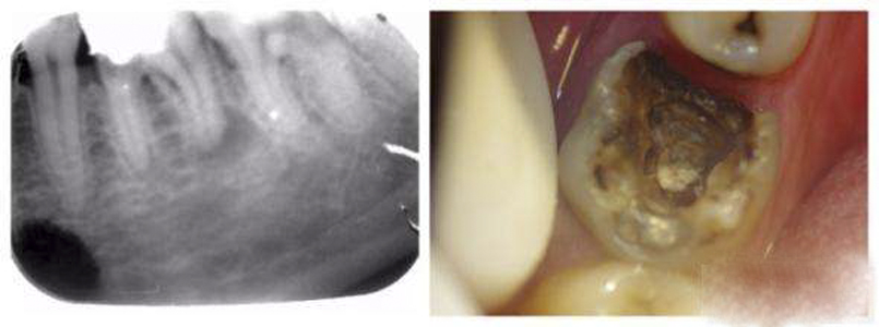 牙髓炎图片 (7)