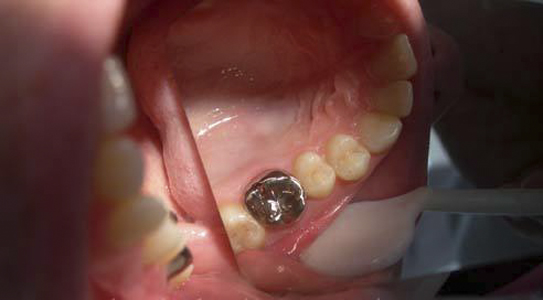 牙髓炎图片 (25)