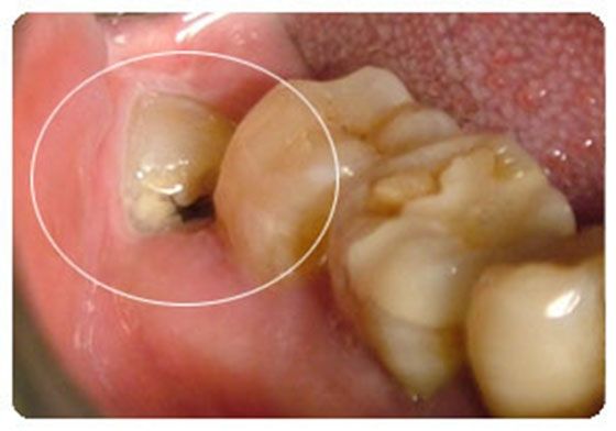 牙髓炎图片 (36)