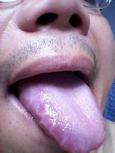 口腔念珠菌感染 (40)