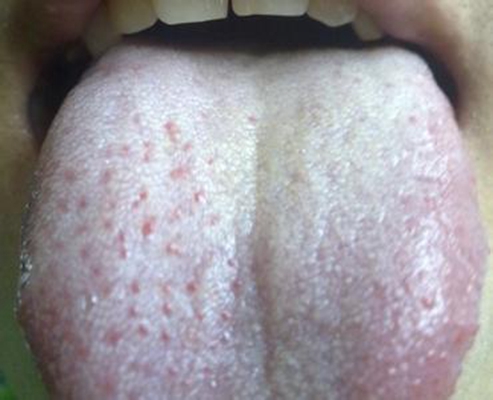 口腔念珠菌感染 (32)