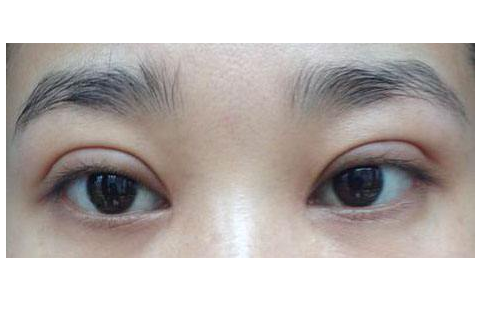 双眼皮修复 (5)