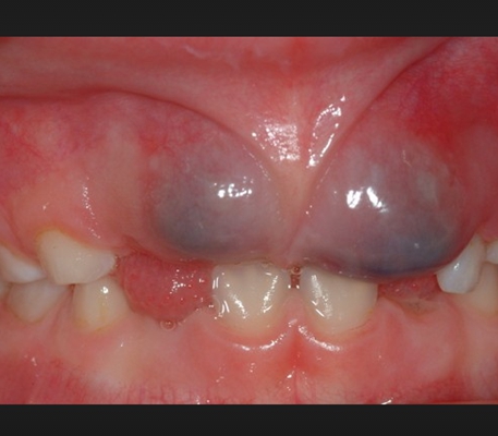 儿童口腔囊肿初期图片图片
