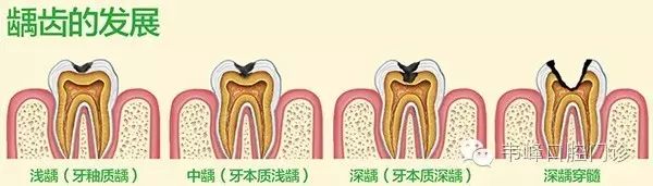 牙齿深龋图片,深龋补牙图片,浅龋图片_大山谷图库