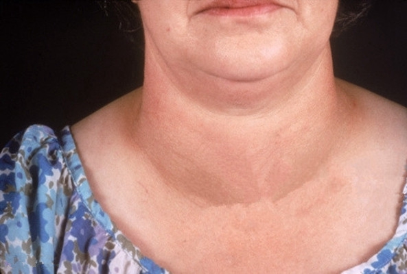甲亢的早期脖子图片 (6)