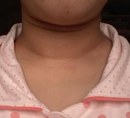 甲亢的早期脖子图片 (6)