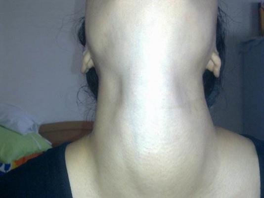 女性甲亢早期脖子图片图片