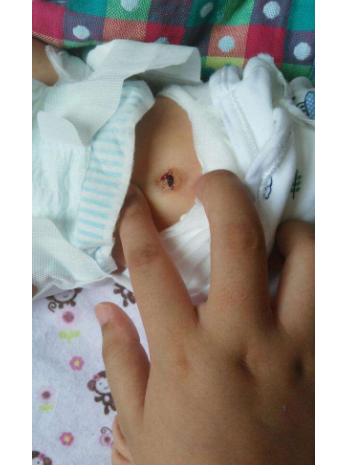 新生儿脐带半脱落图片图片
