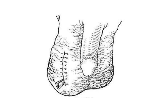 精索曲张睾丸下坠时图片 (22)