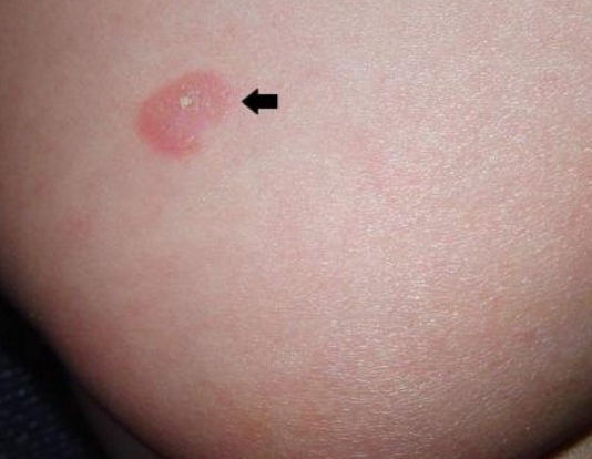 梅毒前期小红点图片 (13)