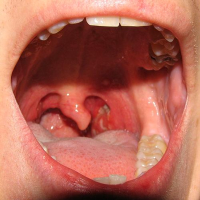 喉咙发炎的症状图片