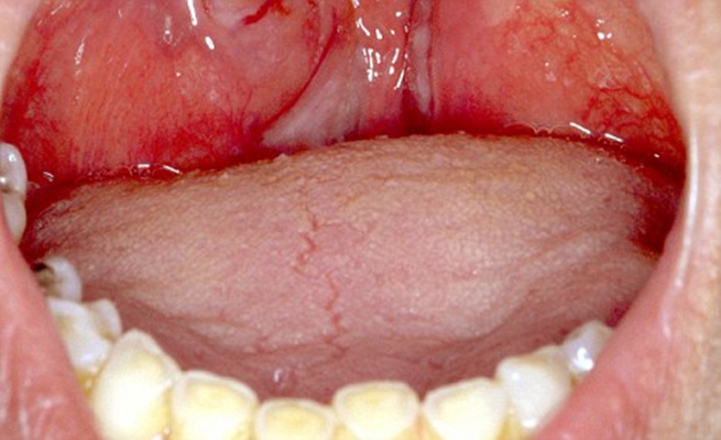 口咽癌图片初期图片
