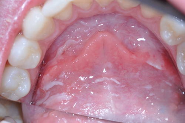 口咽癌 (4)