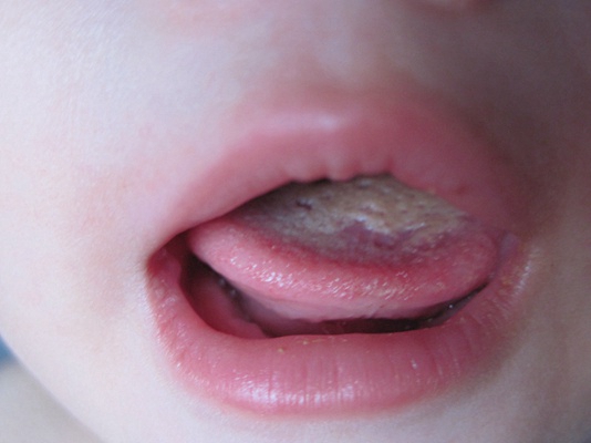 婴儿口腔炎的症状图片图片