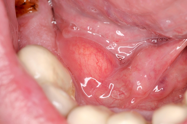口咽癌 (18)