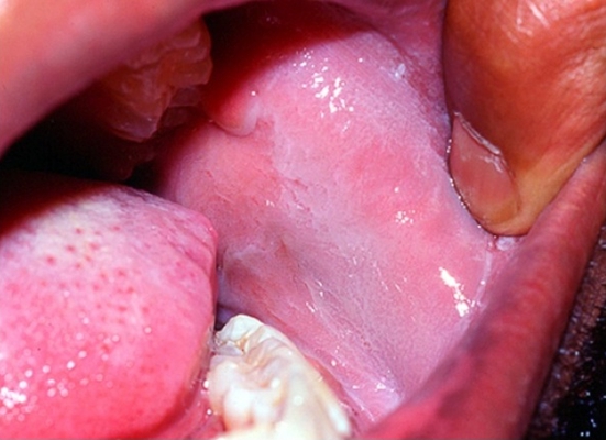 口咽癌 (23)