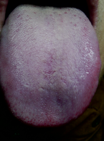 舌炎症状图片