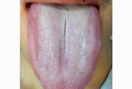 胃炎的症状舌头图片 (60)