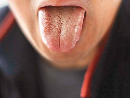 胃炎的症状舌头图片 (58)