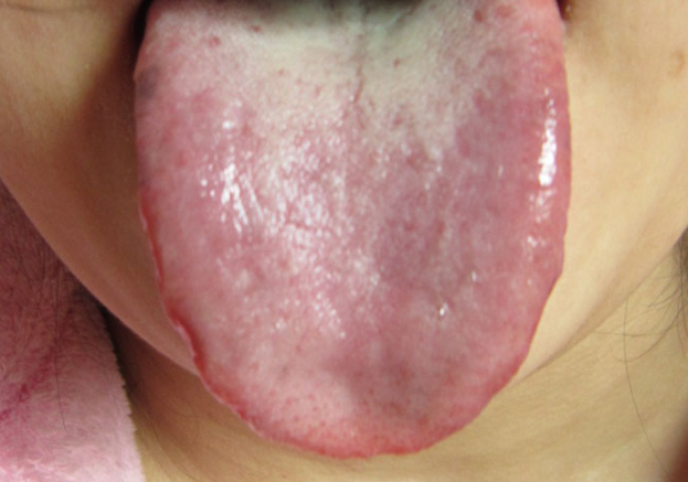 胃炎的症状舌头图片 (55)