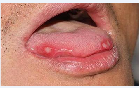 口腔白色念珠菌感染 (1)