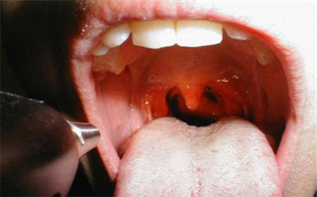 鼻咽癌早期症状图片