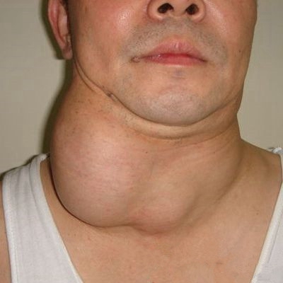 甲亢患者脖子图片图片