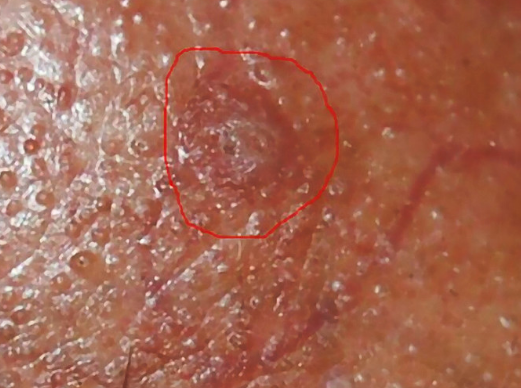 尖锐疣湿疹初期图片图片
