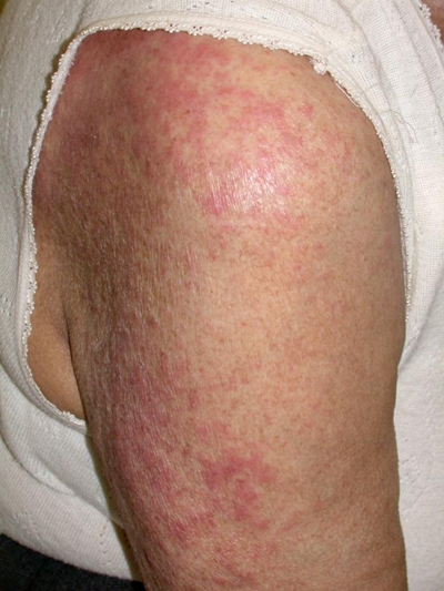 湿疹图片和症状 (47)