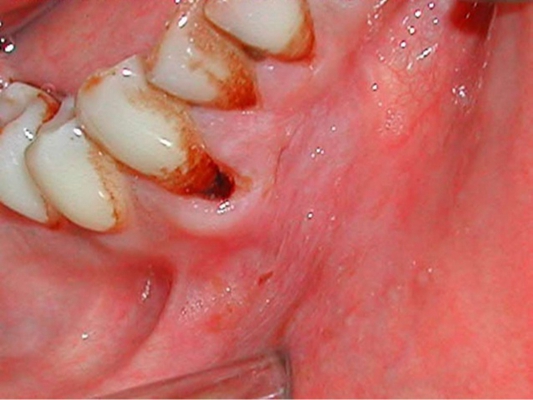 口咽癌 (35)