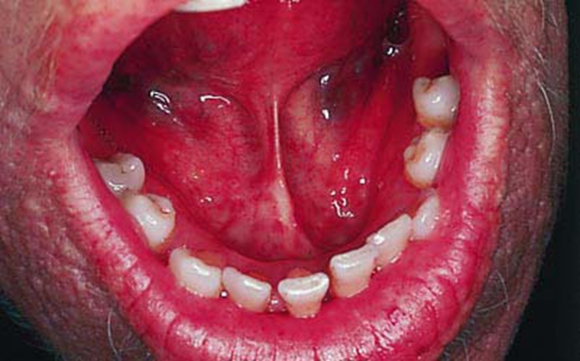 口咽癌 (38)