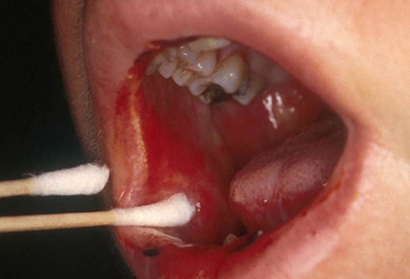 口咽癌 (13)